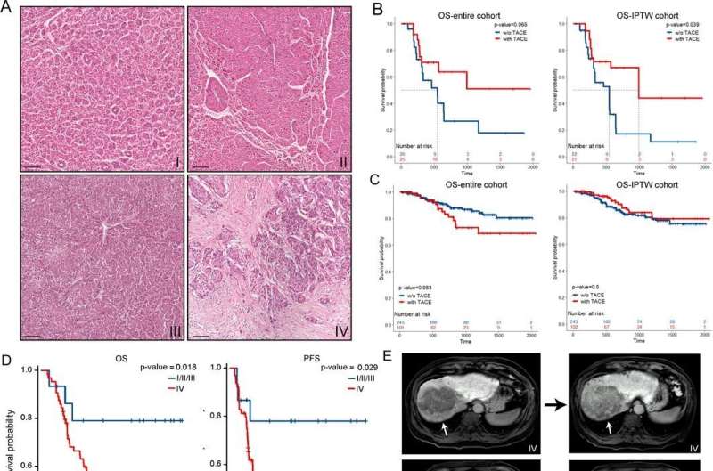 Morphology-based gross classification system for HCC stratification