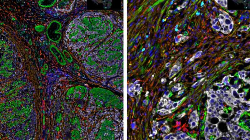 The complex tumour immune microenvironment in patient samples of muscle-invasive bladder cancer, captured using develop a new multiplex immunofluorescence panel. Credit: Integrative Pathology Unit at The ICR and The Royal Marsden NHS Foundation Trust 