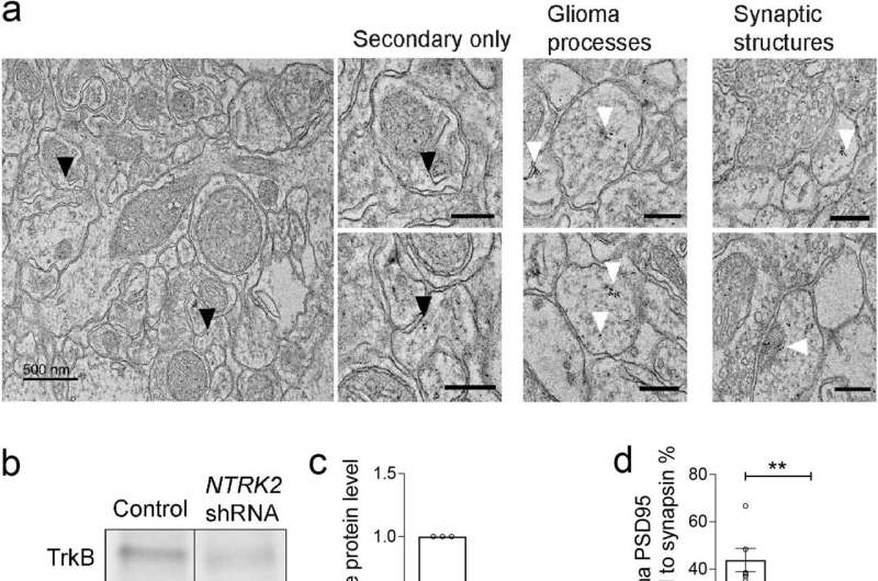 NTRK2 knockdown reduces colocalisation of neuron-to-glioma synaptic puncta, and optogenetic modeling of glioma membrane depolarization. Credit: Nature (2023). DOI: 10.1038/s41586-023-06678-1