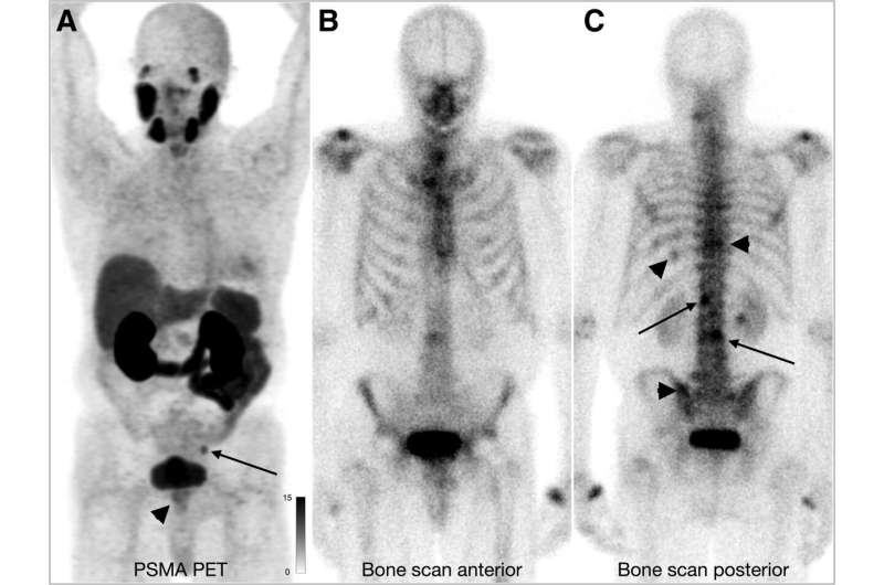 A 74-y-old man at initial staging with PSMA PET that demonstrates low uptake in primary tumor (A, arrowhead) and left pelvic side wall node (A, arrow). Bone scan was read as positive by 2 of 3 readers. One reader read 2 lesions in lumbar spine (C, arrows), and second reader read additional lesions in ribs, thoracic spine, and sacrum (C, arrowheads). This case is false-positive on bone scan. Credit: Journal of Nuclear Medicine (2023). DOI: 10.2967/jnumed.123.265916