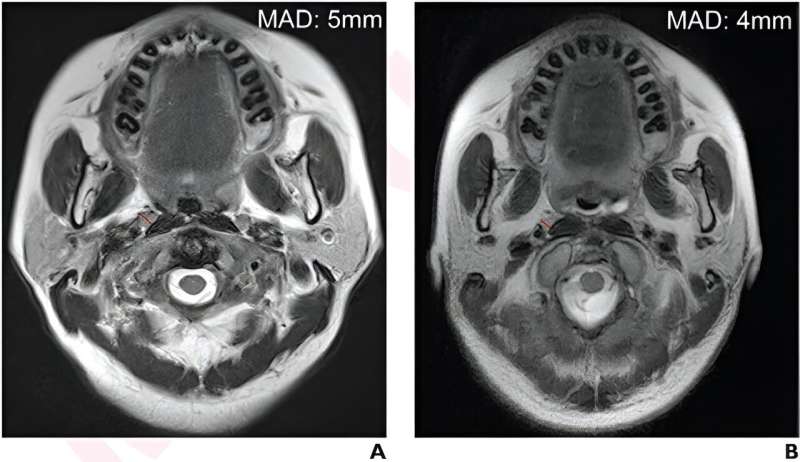 Larger lymph node threshold optimizes nasopharyngeal carcinoma outcomes