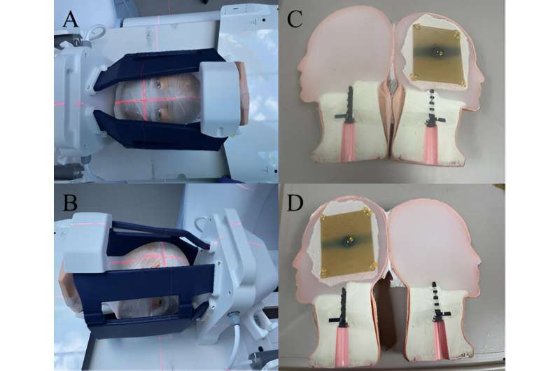 Study reveals high accuracy of MR-guided radiotherapy for intracranial itereotactic radiosurgery