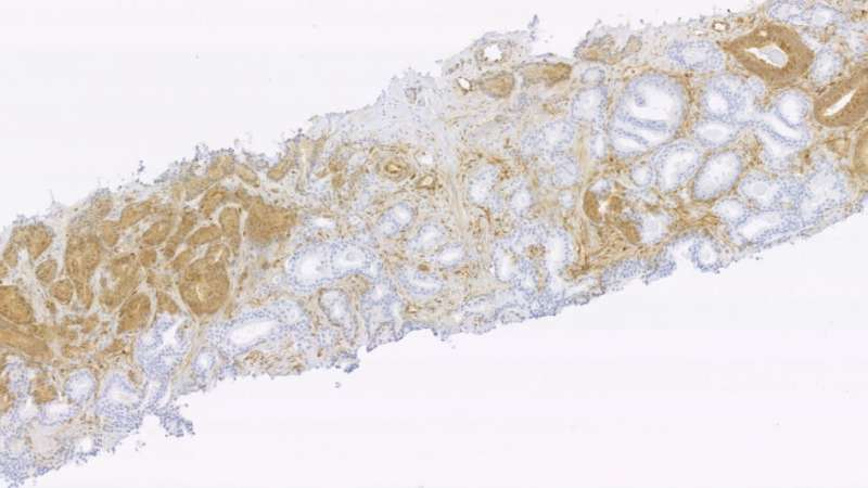 Biological markers identified as powerful predictors of prostate cancer relapse following radiotherapy