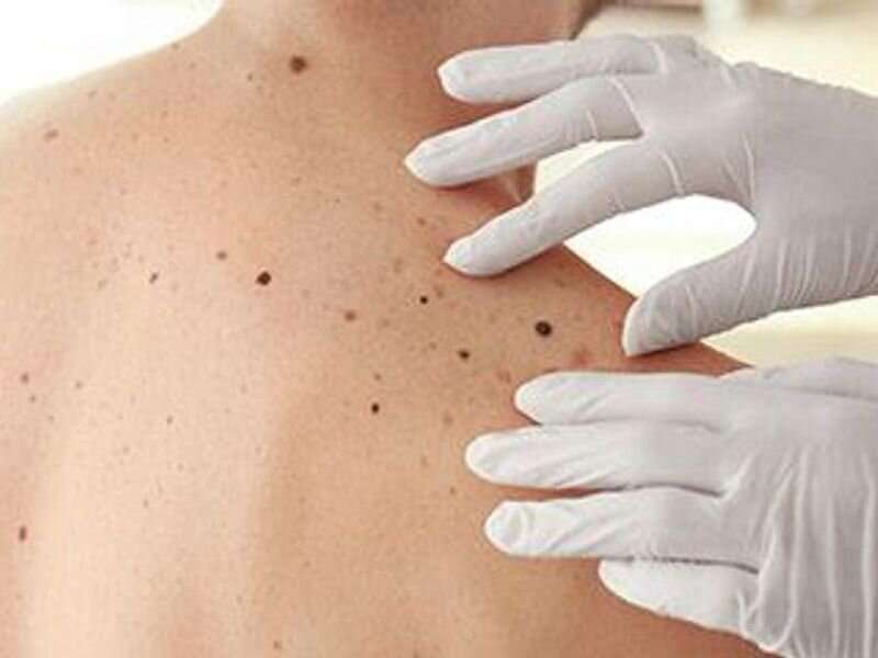 AAD: risk for skin cancer higher for adults with atopic dermatitis