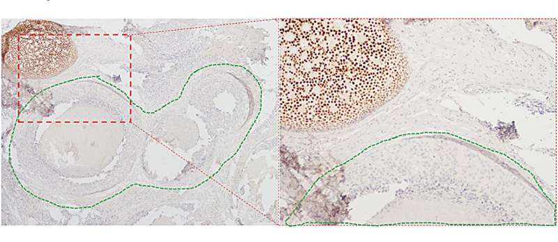 Multiclonality of estrogen receptor expression in ductal carcinoma in situ (DCIS)