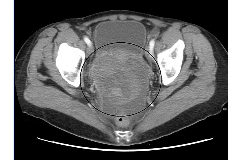 Potential target for reversing drug resistance in ovarian cancer identified