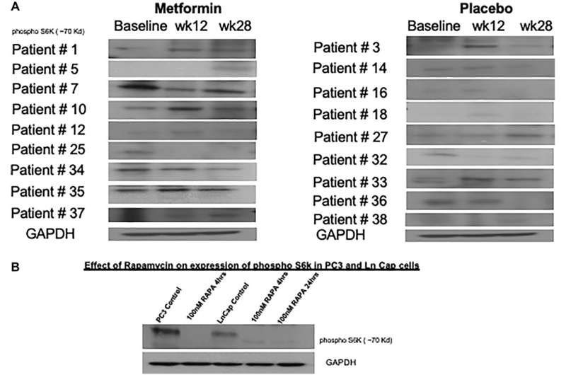 Metformin's role in preventing metabolic syndrome during androgen deprivation therapy: a Phase II study