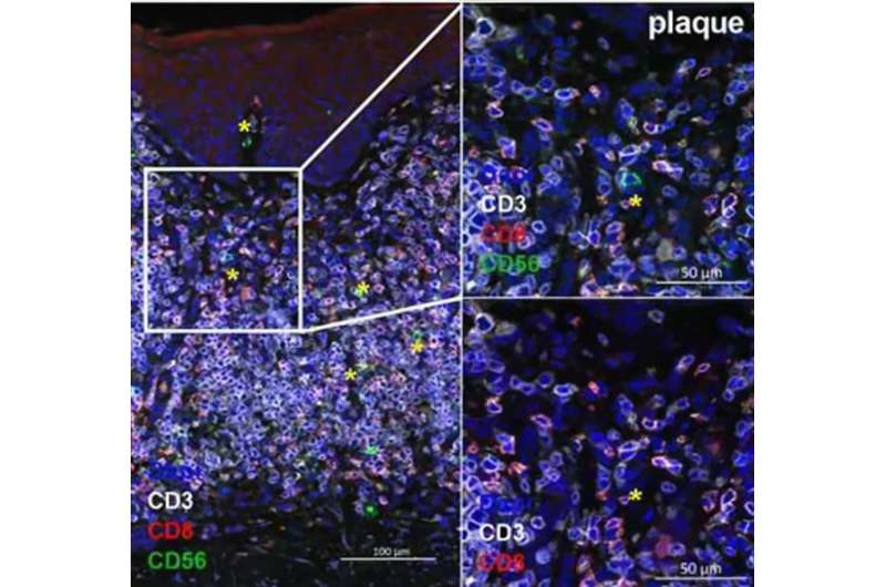 Impaired natural killer cells in cutaneous lymphoma: Possible new targets for future therapies