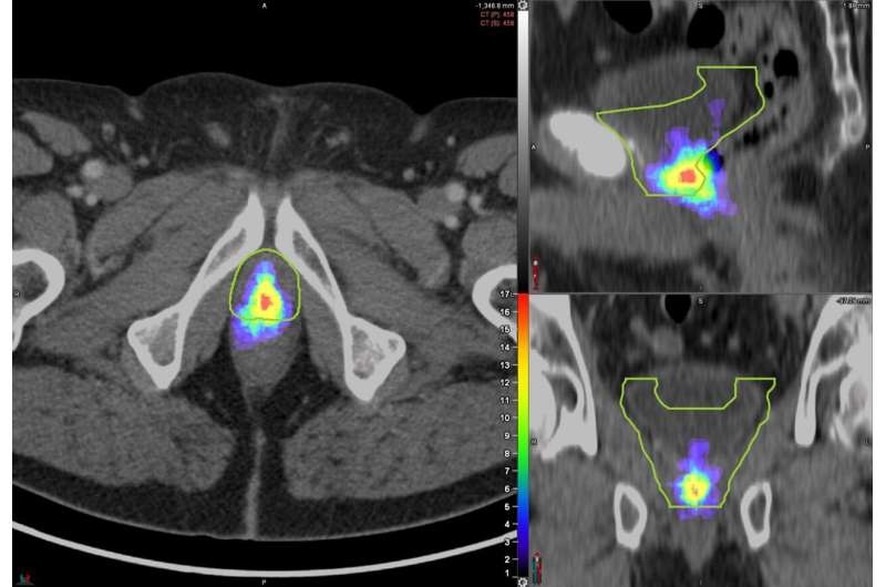 PSMA PET scanning can improve decision making for prostate cancer treatment 