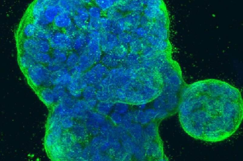 First immunotherapy success for triple-negative breast cancer