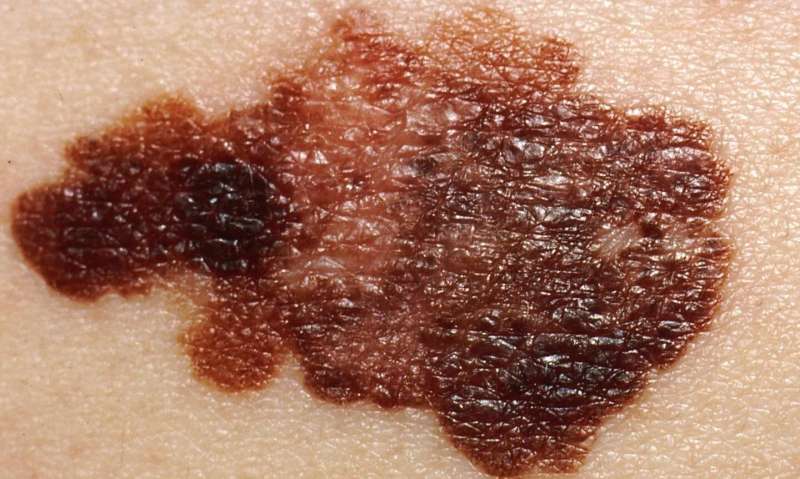 International study designed to identify melanoma patients with high-risk disease