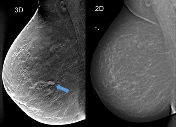 3-D mammography detected 34% more breast cancers in screening