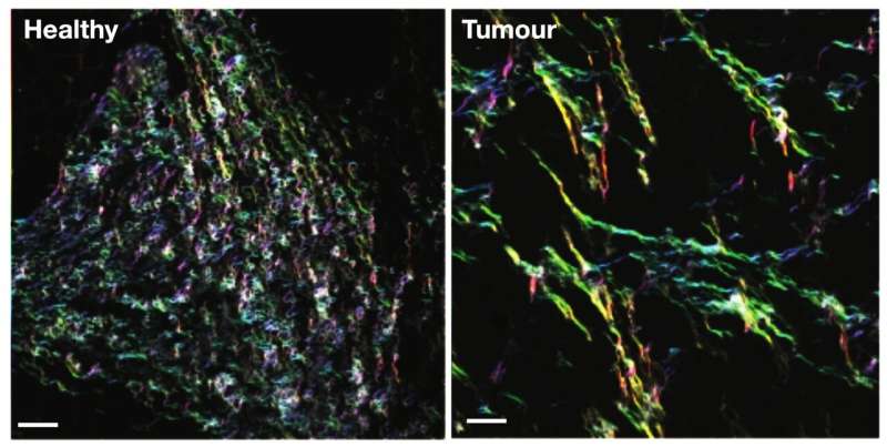 Collagen a key player in breast cancer metastasis