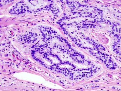 Immunotherapy may become new first line treatment in some metastatic colorectal cancers