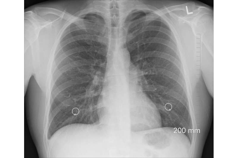 Targeted lung cancer drug shows promise in phase I/II clinical trial 