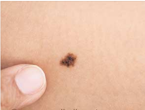 Advancing Against Melanoma With Microneedles Technology