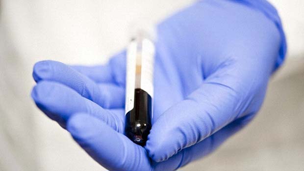 Personalised blood test could help predict which lung cancers might return