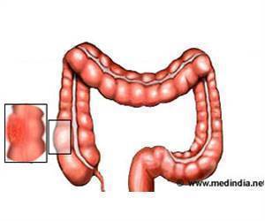 Blood Stem Cell Mutations Exacerbate Colon Cancer Growth