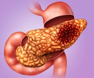 Lorazepam may Fuel Poor Pancreatic Cancer Outcome!