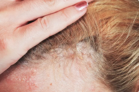 Why Psoriasis Causes Hair Loss
