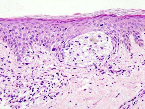 Researchers identify molecular characteristics of leptomeningeal melanoma metastases