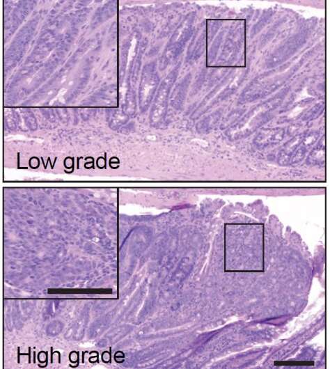 Two genes slow down the development of intestinal tumoursType:  News 6 January 2020