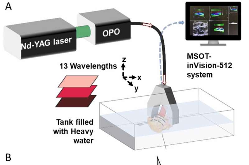 How optoacoustic imaging plays a role in assessing the success of breast cancer surgery