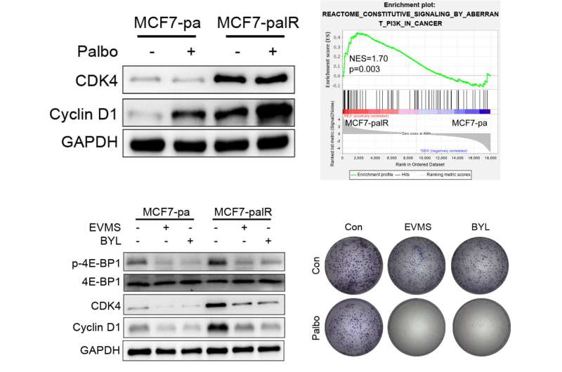 Overexpressed Cyclin D1 and CDK4 proteins are responsible for the resistance to CDK4/6 inhibitor in some breast cancer 