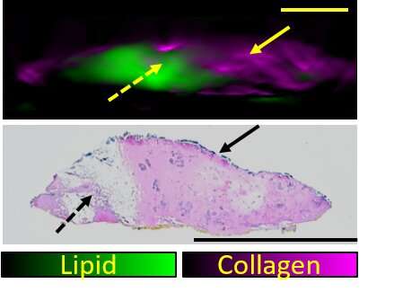 How optoacoustic imaging plays a role in assessing the success of breast cancer surgery