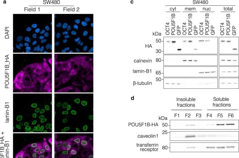 Genetic discovery could improve treatment of colorectal cancer