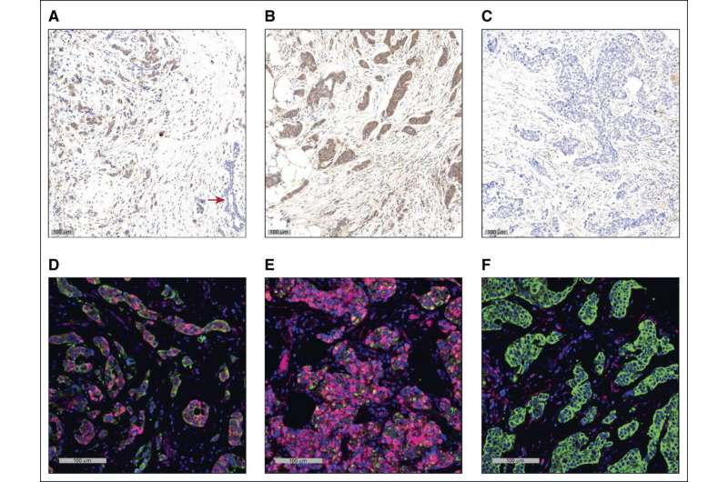 Scientists find new marker that predicts early recurrence of breast cancer