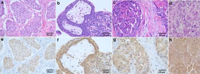 First test of anti-cancer agent PAC-1 in human clinical trials shows promise