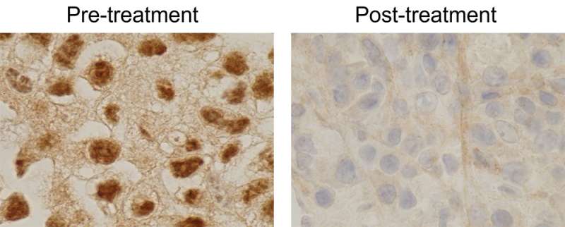 Tackling resistance to HIF2 drugs with an RNA-based therapy