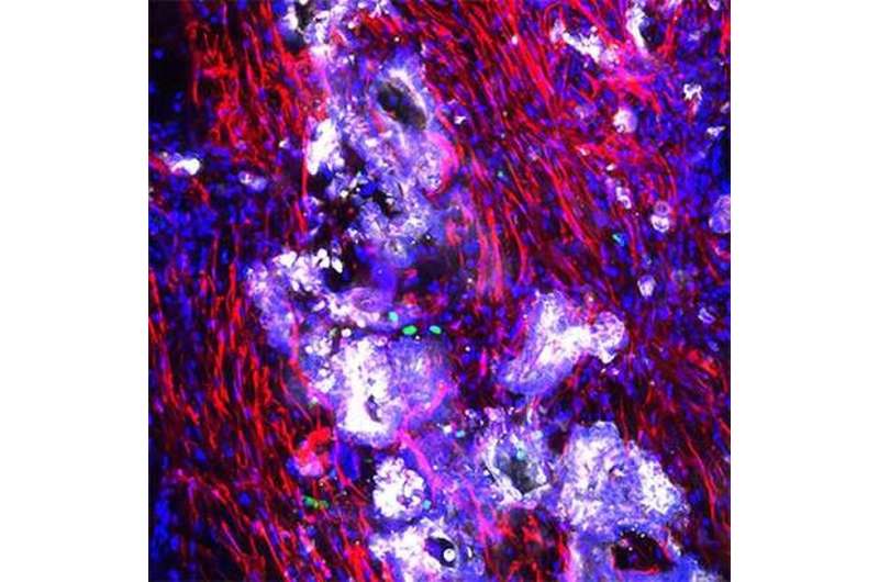 Appendiceal cancer gets its own preclinical model