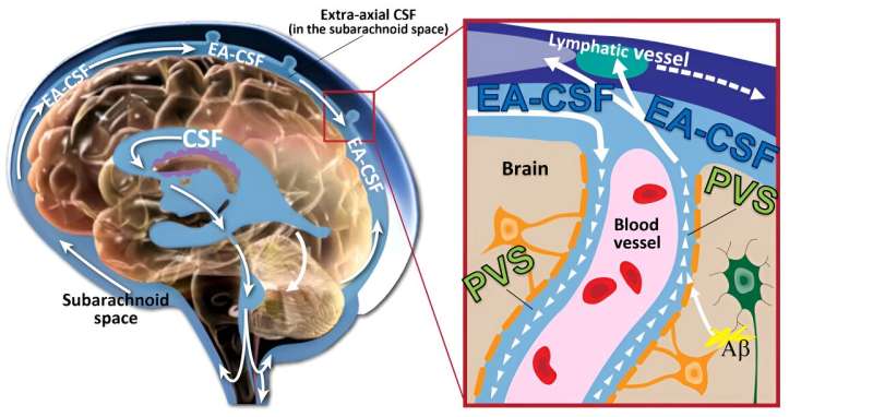 Enlarged spaces in infant brains linked to higher risk of autism, sleep problems