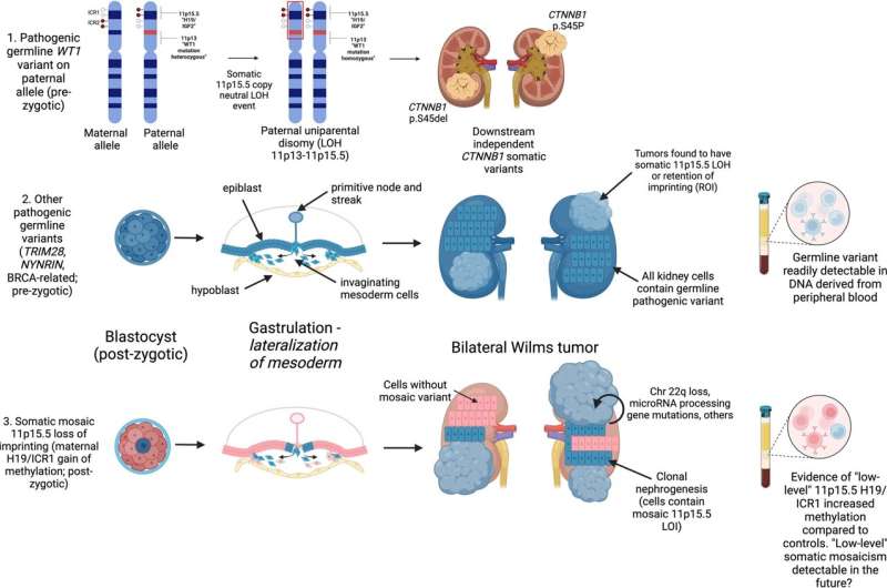 Unraveling predisposition in bilateral Wilms tumor