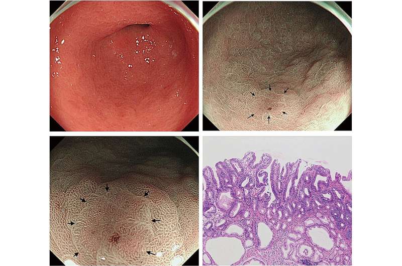 Narrow-band imaging at low magnification can detect lesions overlooked by white-light imaging