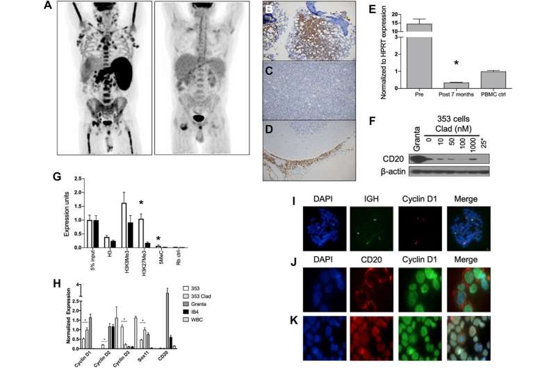 Oncotarget | Combined epigenetic and immunotherapy for blastic and classical mantle cell lymphoma