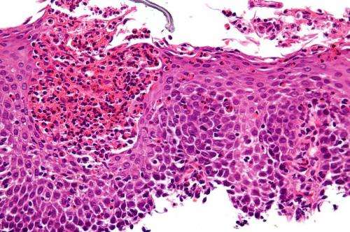 Eosinophilic esophagitis