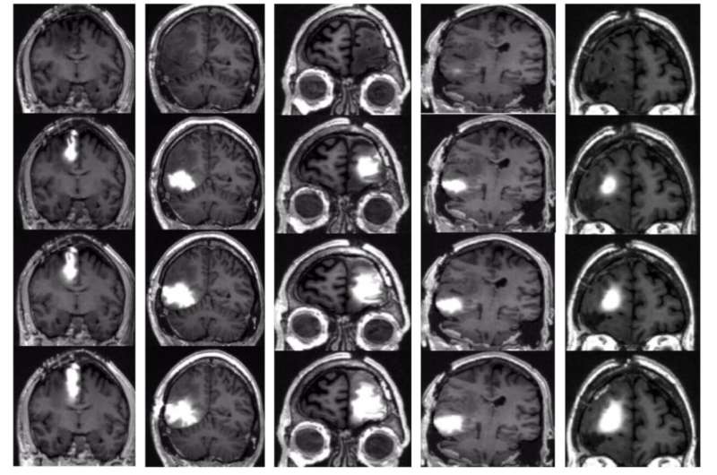 Implanted Pump Safely Delivered Chemo Straight to Brain in Patients with Brain Cancer