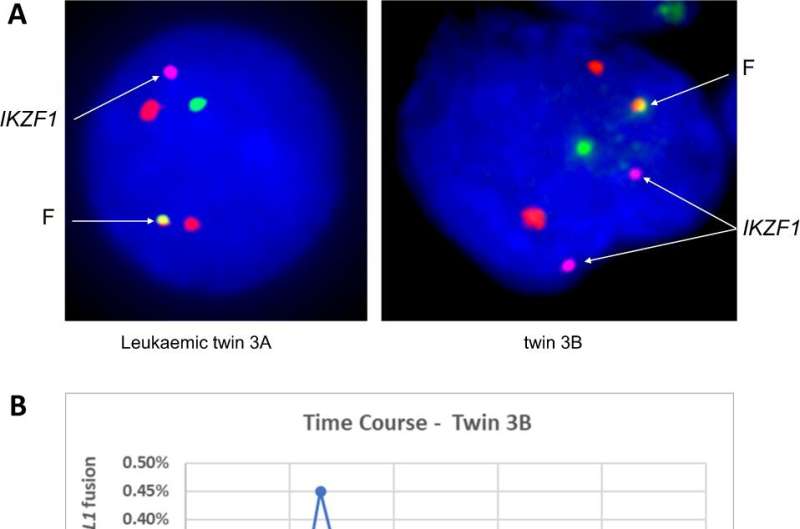 Twin study confirms childhood leukemia starts in the womb and could help guide screening when only one twin is affected 