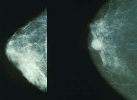 breast cancer