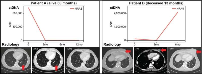 Blood-based biomarker may redefine future treatment for advanced melanoma