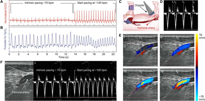 An implantable wireless cardiac pacemaker