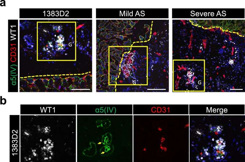 iPSC-derived kidney organoids to model a lifelong renal disease