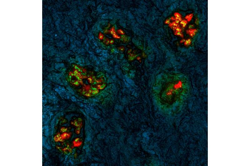 Researchers develop innovative technique for distinguishing tumor from normal tissue