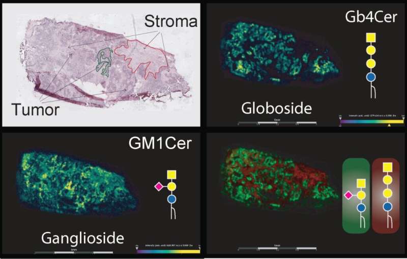 Sugar modifications the key to unlocking ovarian cancer secrets