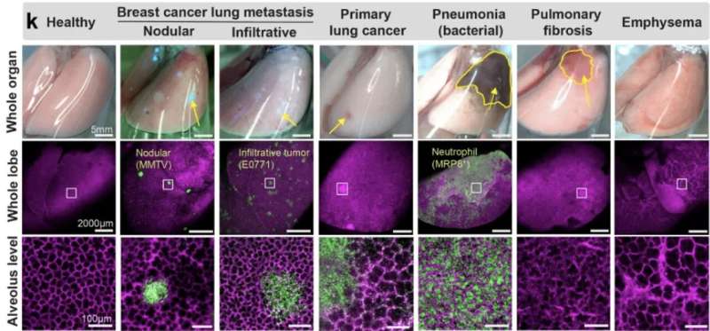 Q&A: 'Crystal ribcage' technology pioneers new approaches to lung health