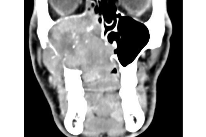 Treatment strategies for adenoid cystic carcinoma of the head and neck