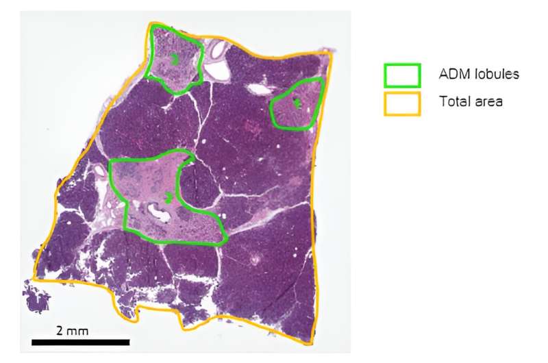 Pancreas 'crosstalk' may influence course of type 1 and type 2 diabetes